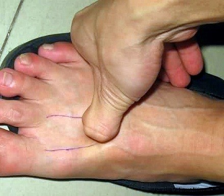 Massage du 3ème point du méridien du foie