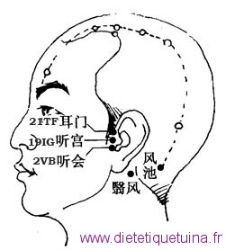 Les 3 points à l'avant du tragus de l'oreille 3 points devant l'oreille